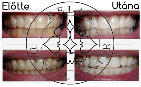 fogfehérítés és fogkőlevétel
